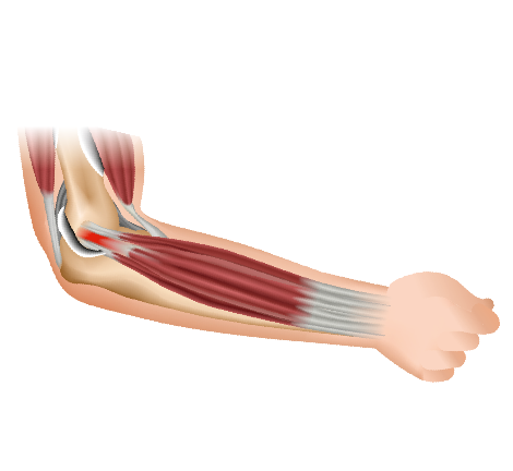 Medical illustration depicting tennis elbow, focusing on inflammation and degeneration of the forearms extensor tendons near the lateral epicondyle